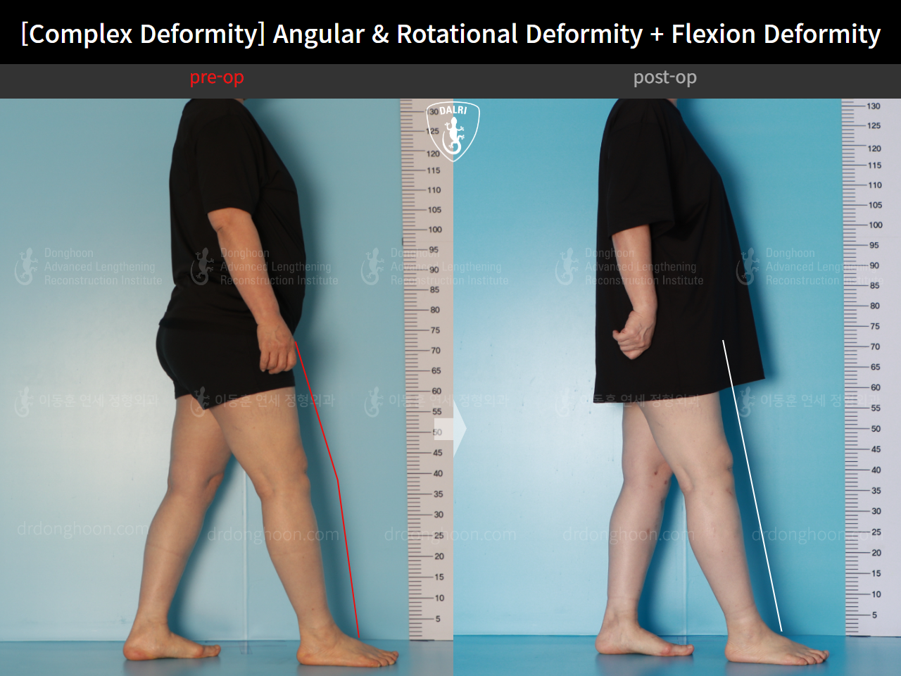 Before and after adult bowlegs, case 16781344, image 5, Dr. Donghoon institute (DALRI)