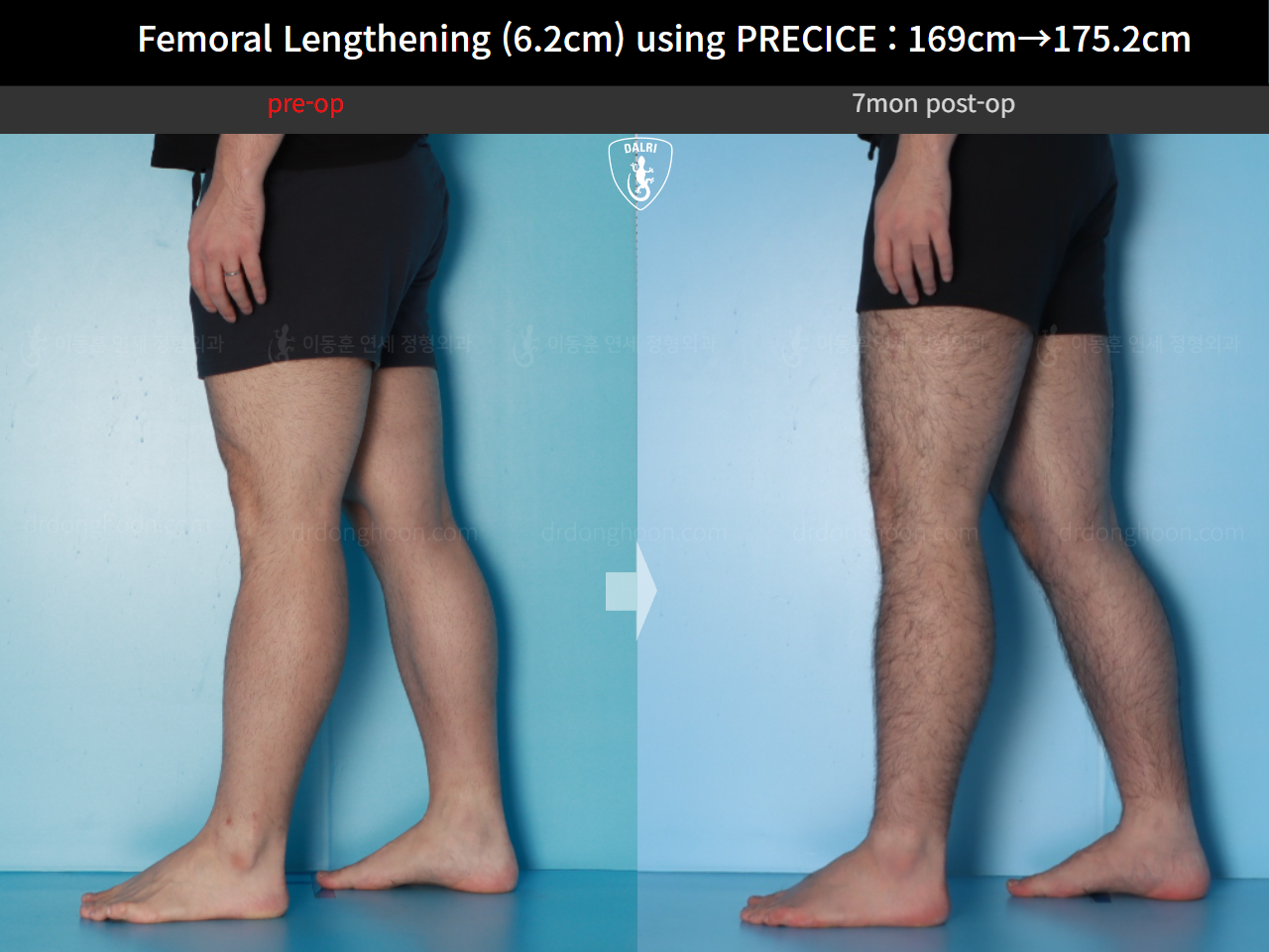 Before and after cll precice, case 20671201, image 9, Dr. Donghoon institute (DALRI)
