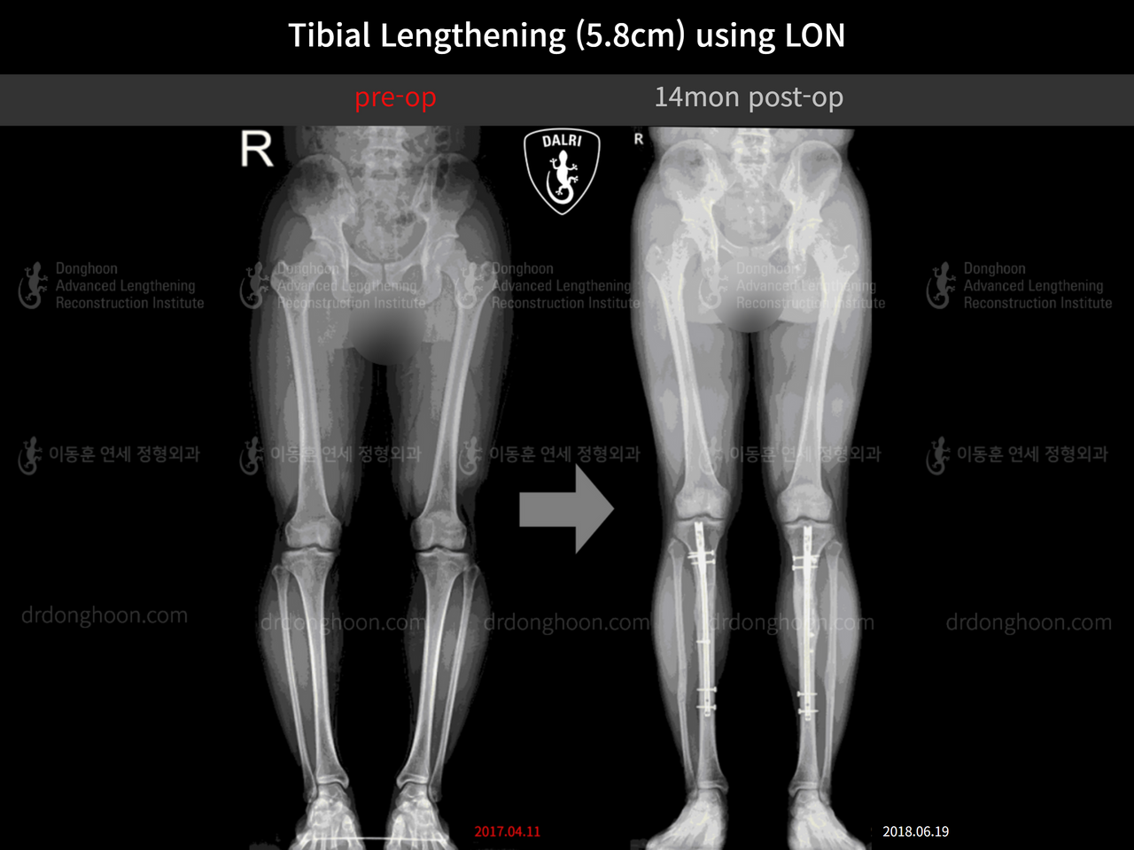 Before and after cll lon, case 4577732, image 9, Dr. Donghoon institute (DALRI)