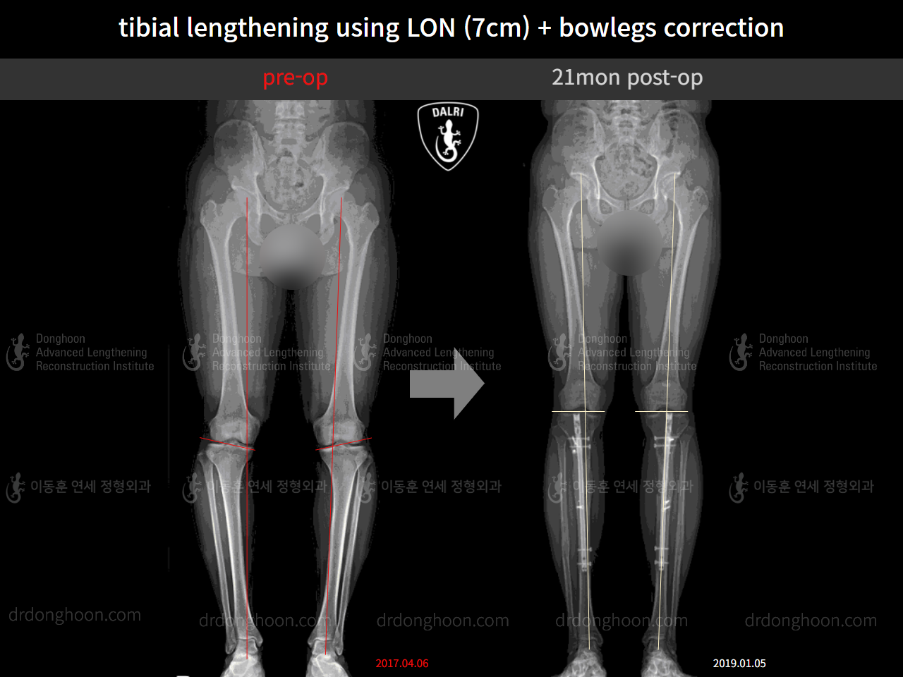 Before and after cll + deformity correction, case 11362707, image 3, Dr. Donghoon institute (DALRI)