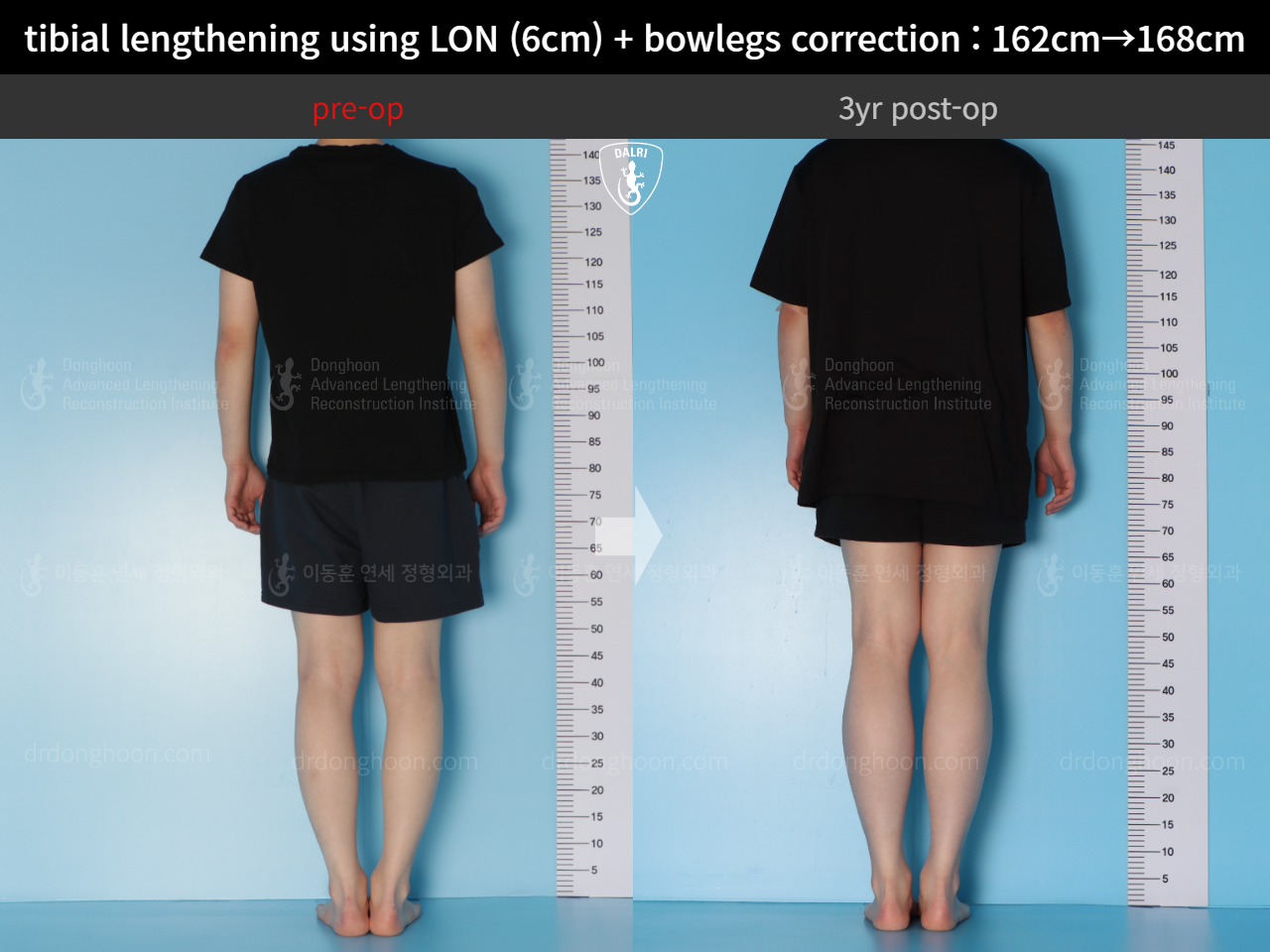 Before and after cll + deformity correction, case 14731799, image 2, Dr. Donghoon institute (DALRI)
