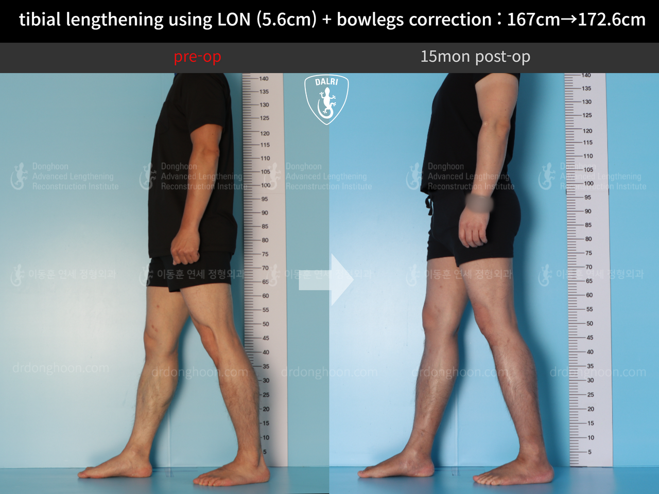 Before and after cll + deformity correction, case 12804946, image 3, Dr. Donghoon institute (DALRI)