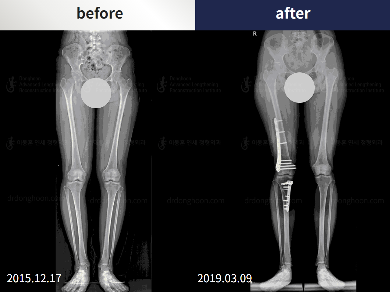Before and after recurrent patella dislocation, case 4594075, image 2, Dr. Donghoon institute (DALRI)