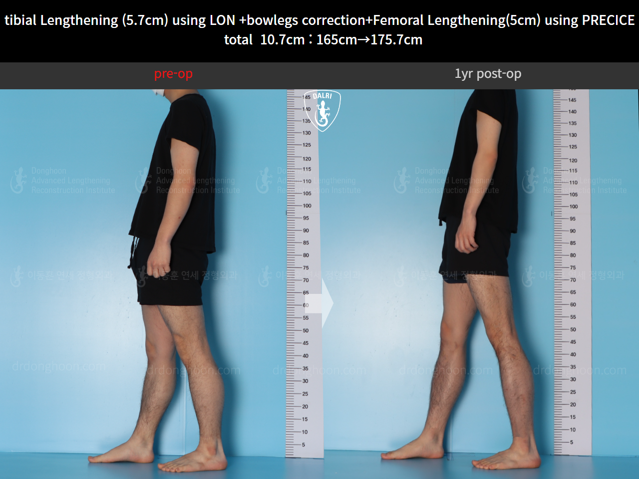 Before and after cll + deformity correction, case 20363398, image 4, Dr. Donghoon institute (DALRI)