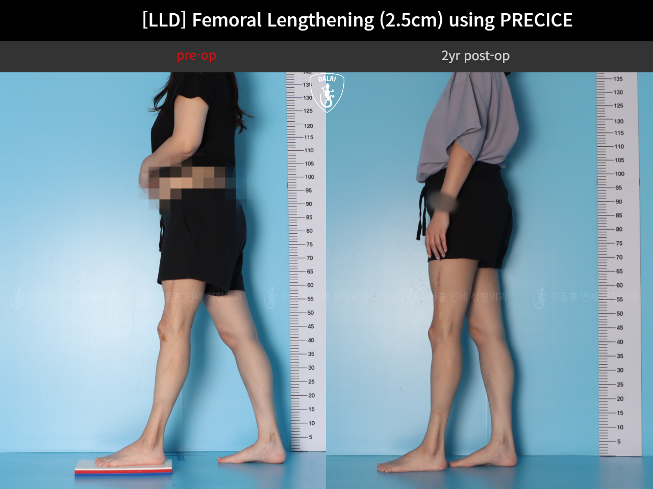 Before and after adult lld, case 89087135, image 3, Dr. Donghoon institute (DALRI)