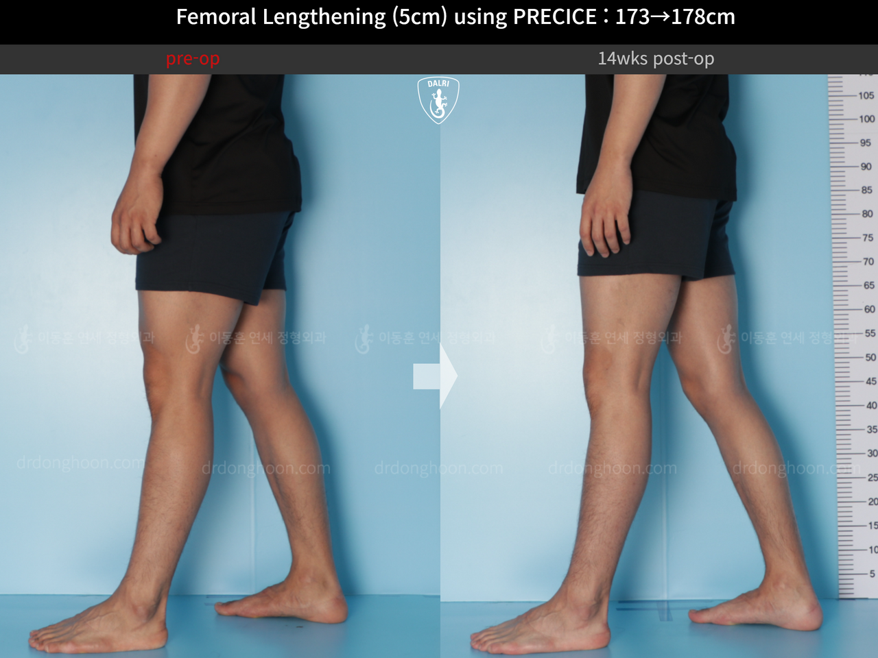 Before and after cll precice, case 14448457, image 8, Dr. Donghoon institute (DALRI)