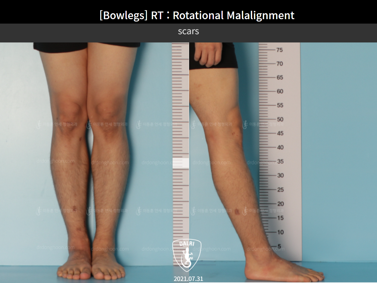 Before and after adult bowlegs, case 9190873, image 4, Dr. Donghoon institute (DALRI)