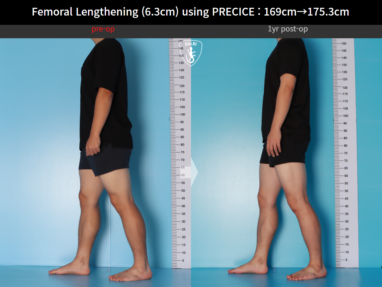 Before and after cll precice, case 16070058, image 8, Dr. Donghoon institute (DALRI)