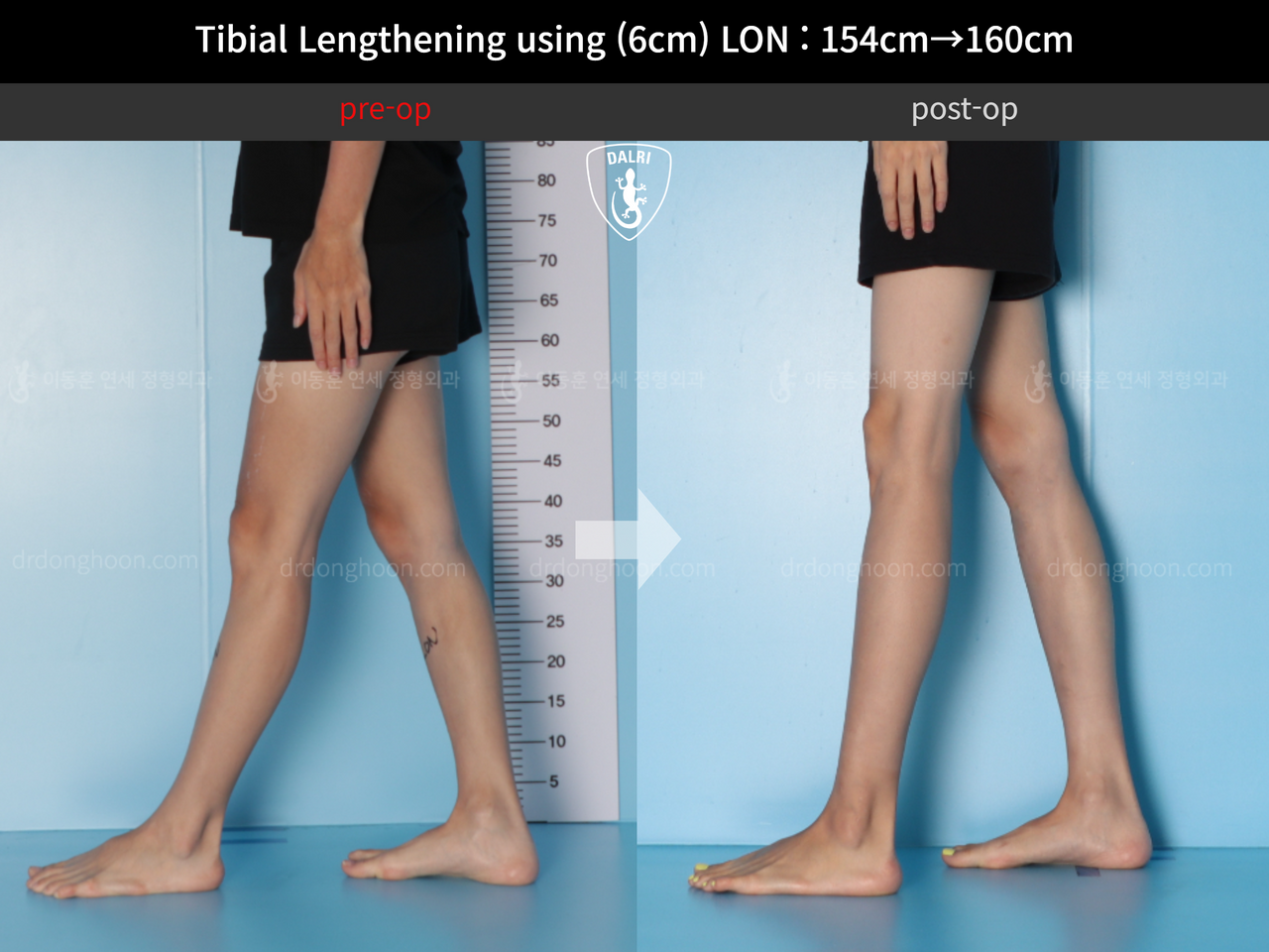 Before and after cll lon, case 12786266, image 8, Dr. Donghoon institute (DALRI)