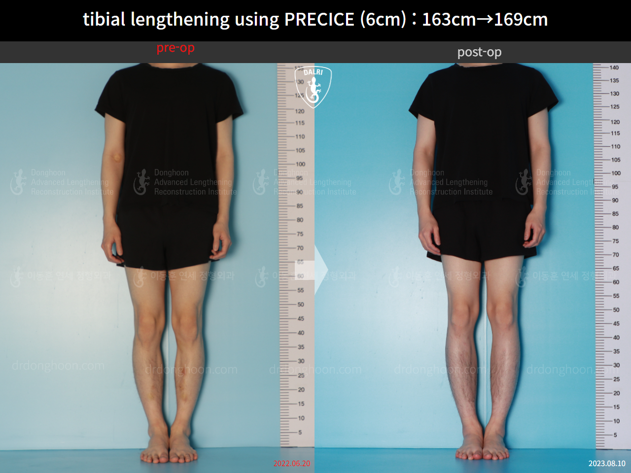 Before and after cll precice, case 16061529, image 1, Dr. Donghoon institute (DALRI)