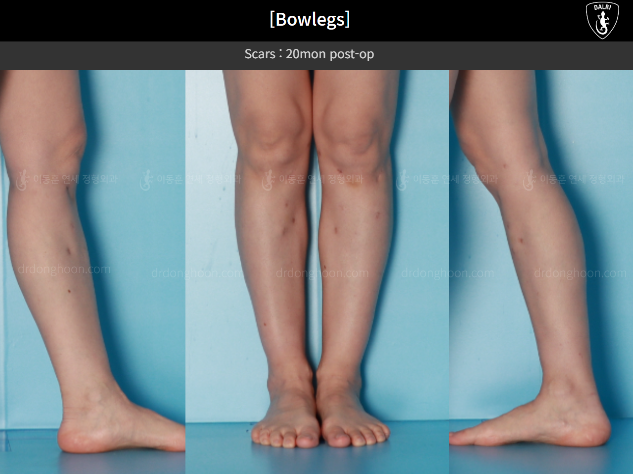 Before and after adult bowlegs, case 16724630, image 9, Dr. Donghoon institute (DALRI)
