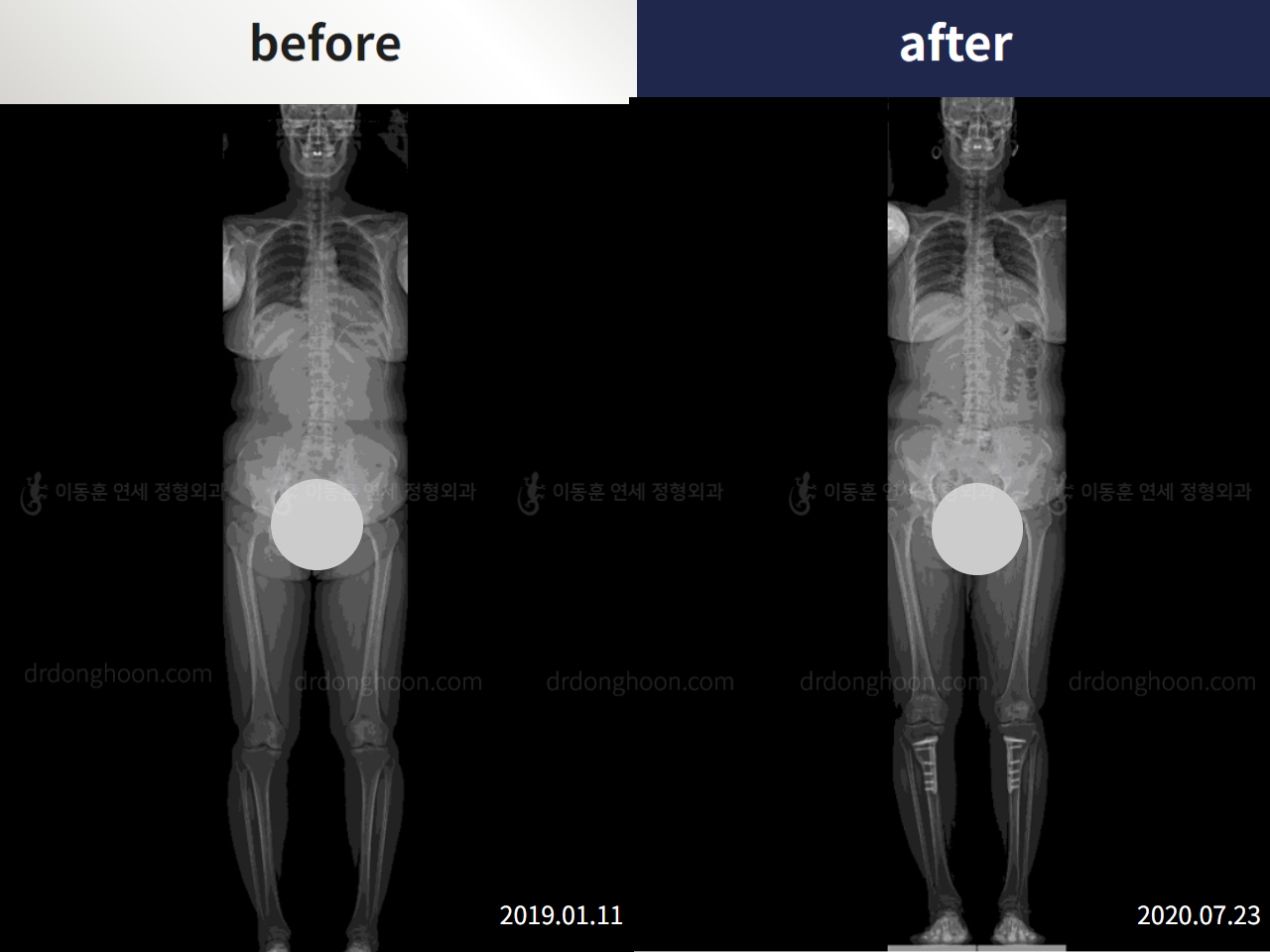 Before and after osteotomy for knee osteoarthritis, case 5302014, image 3, Dr. Donghoon institute (DALRI)