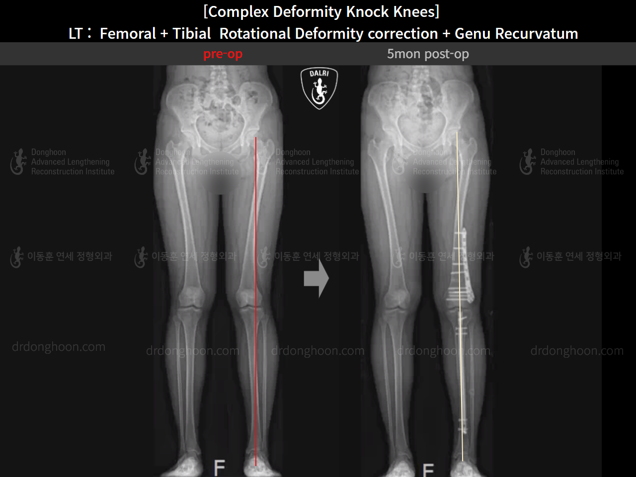Before and after adult knock knees, case 16212764, image 13, Dr. Donghoon institute (DALRI)