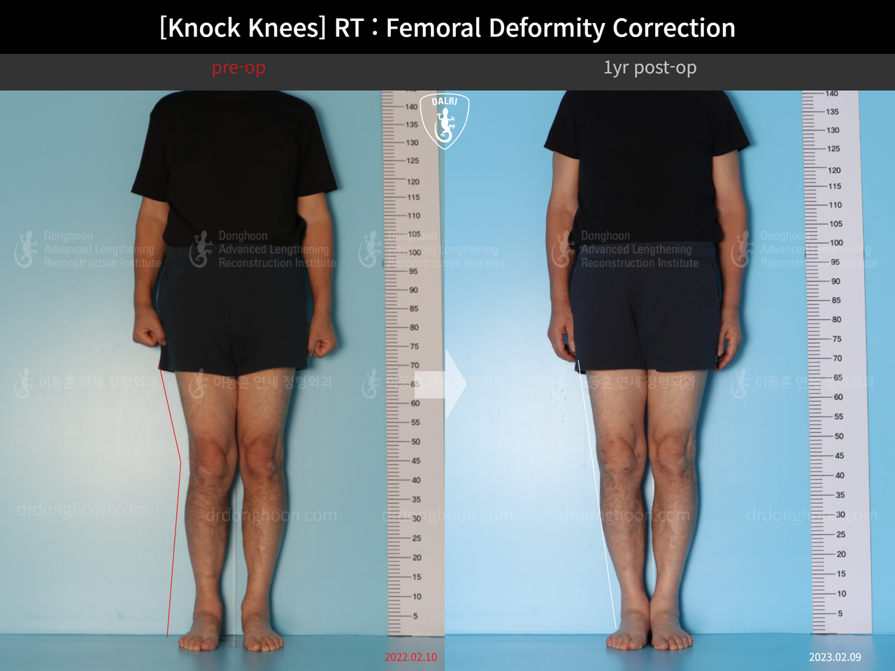 Before and after adult knock knees, case 14236357, image 1, Dr. Donghoon institute (DALRI)