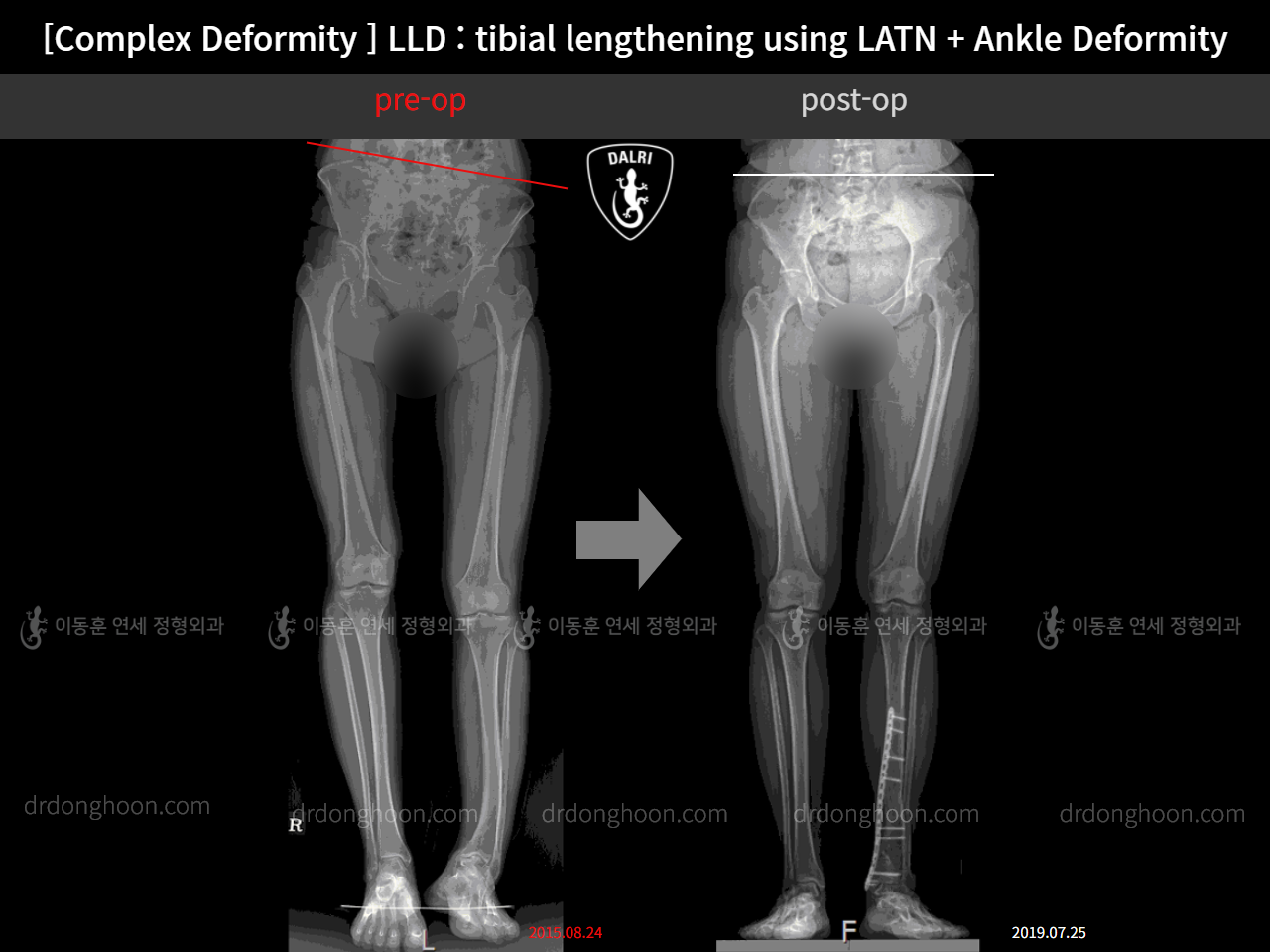 Before and after adult lld, case 11230143, image 3, Dr. Donghoon institute (DALRI)