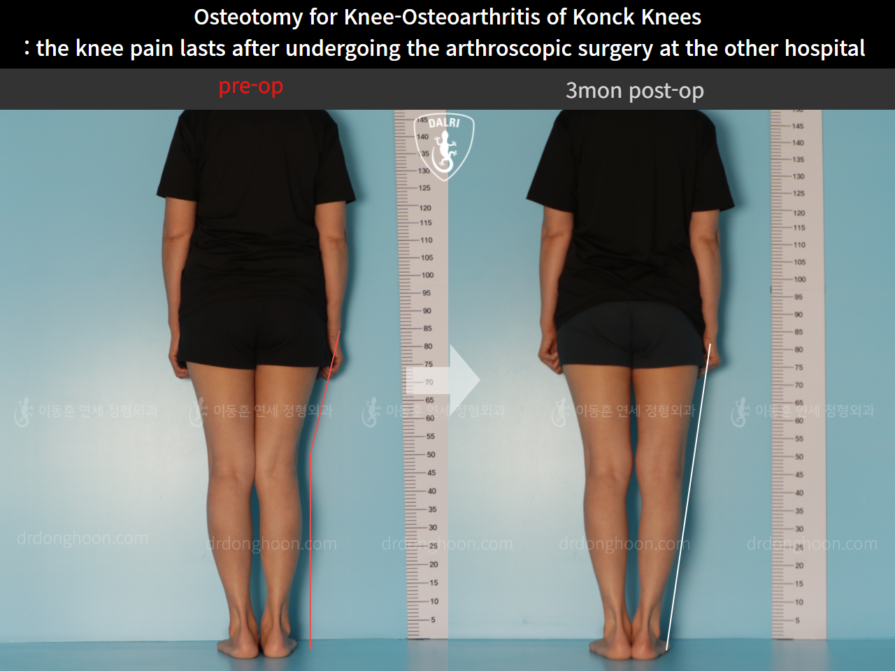 Before and after osteotomy for knee osteoarthritis, case 10664630, image 2, Dr. Donghoon institute (DALRI)