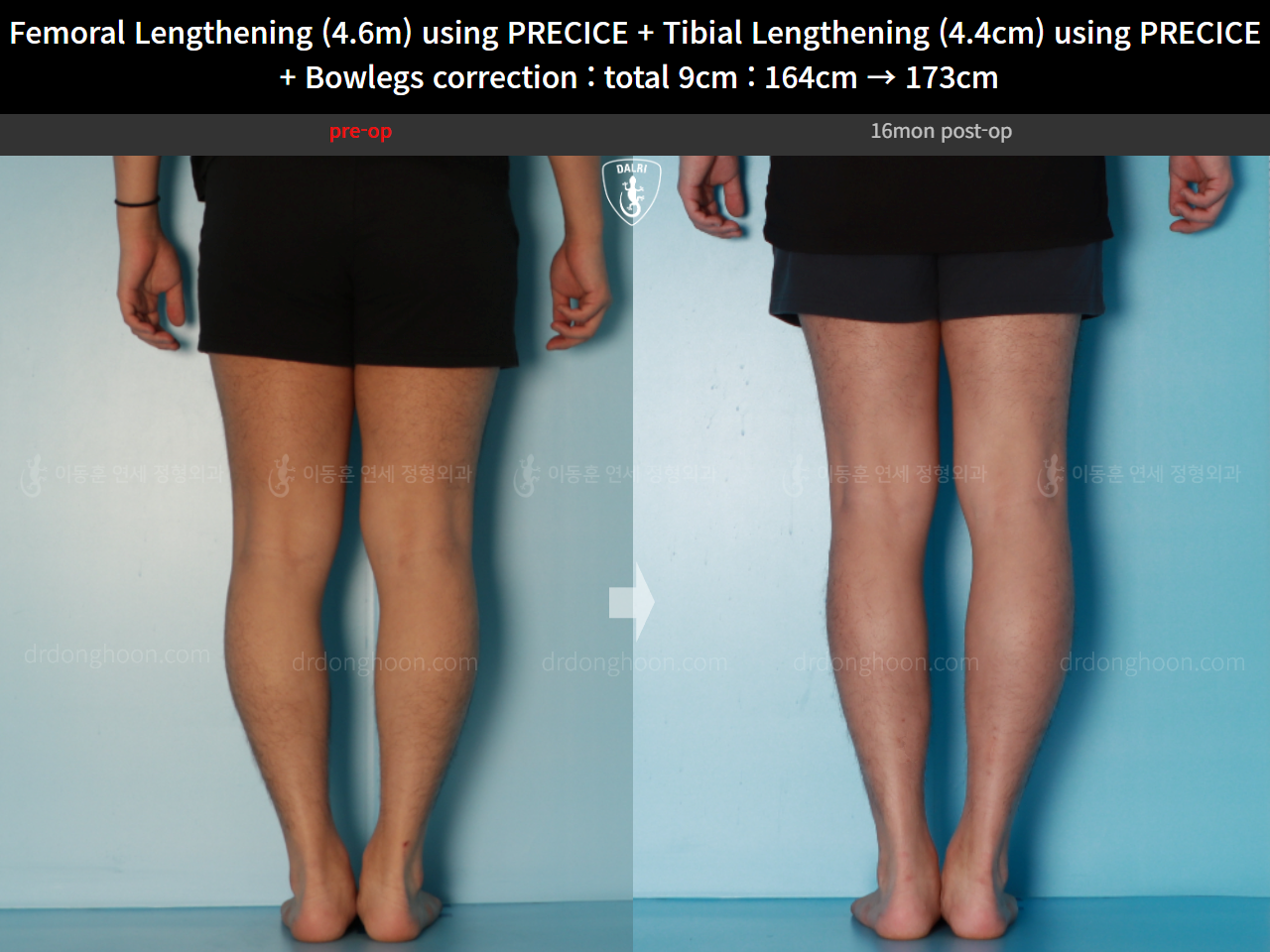 Before and after cll + deformity correction, case 16697522, image 10, Dr. Donghoon institute (DALRI)