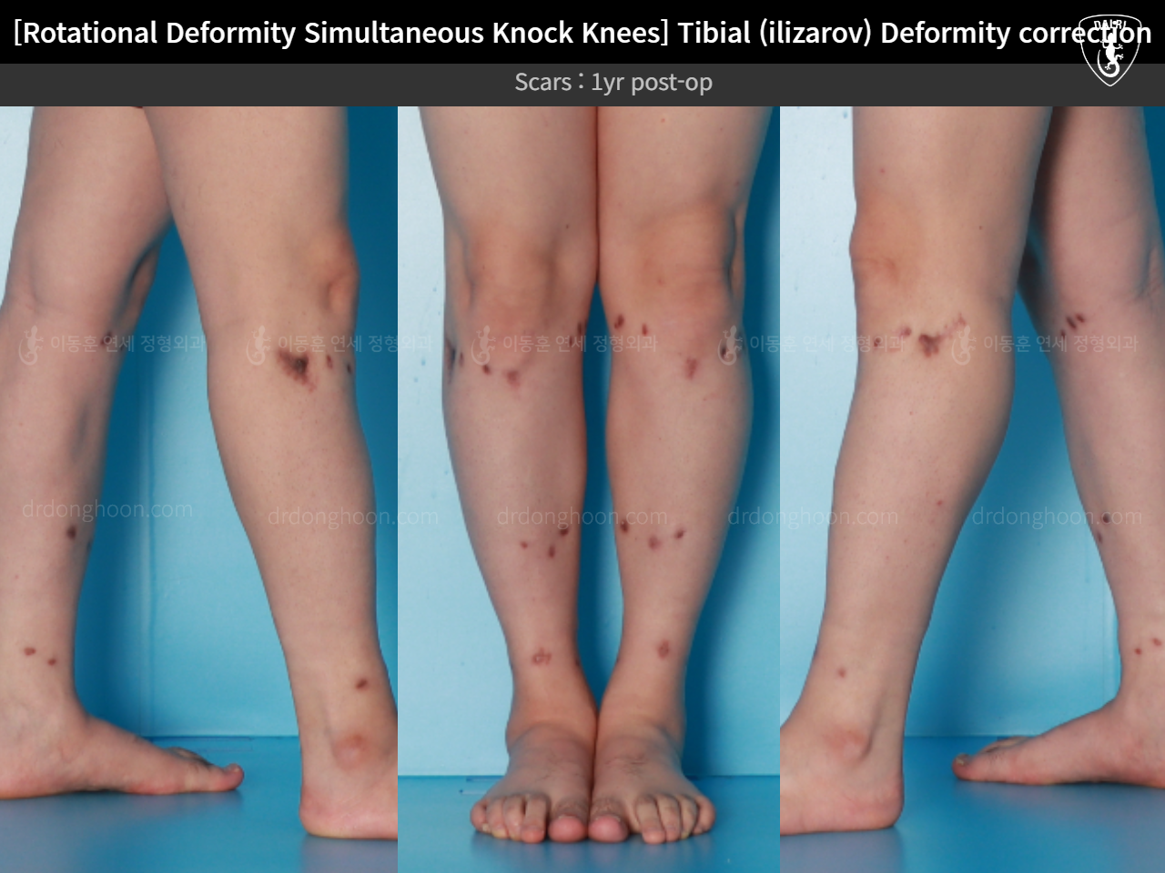 Before and after adult knock knees, case 15977455, image 8, Dr. Donghoon institute (DALRI)