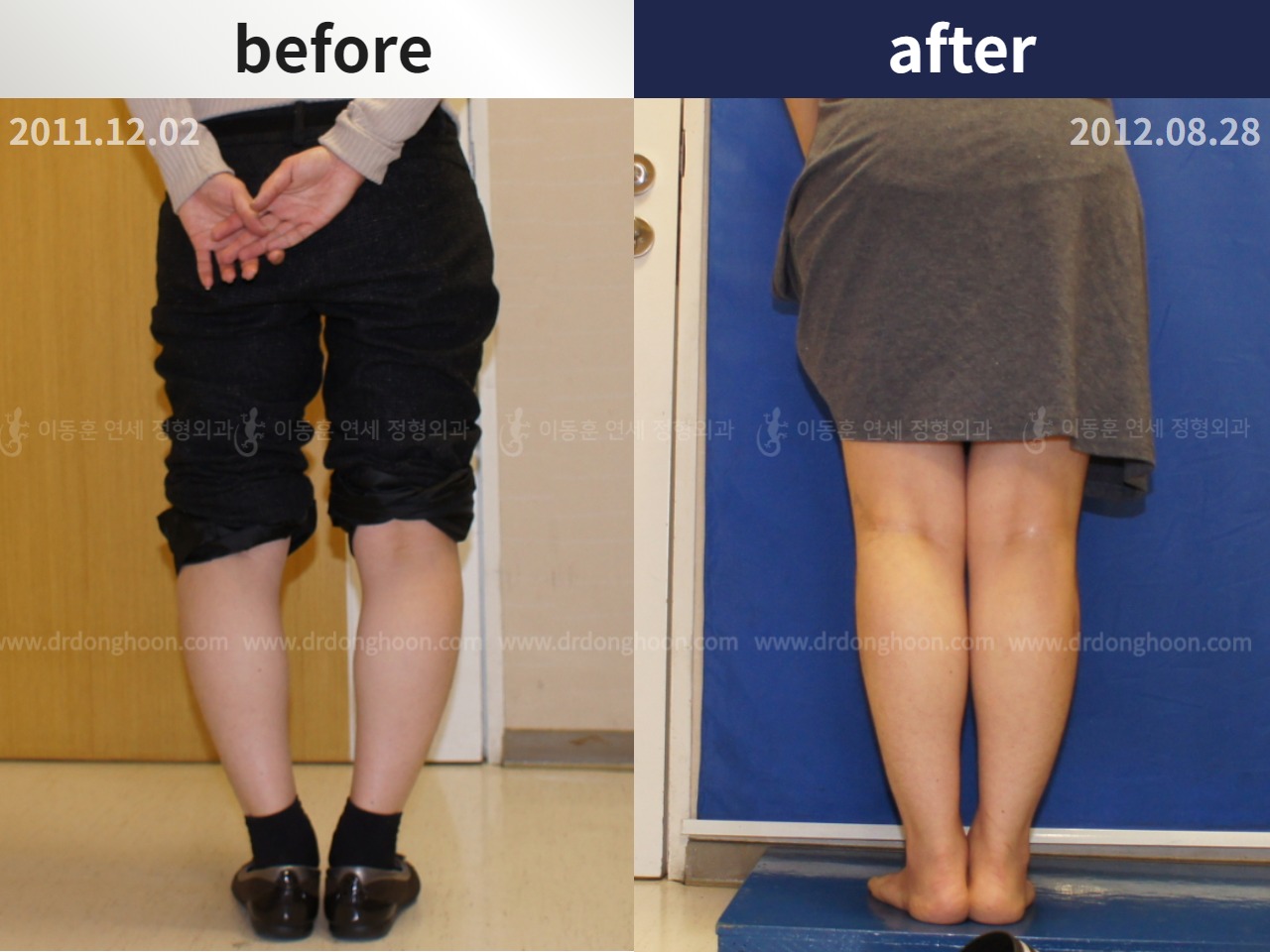 Before and after adult bowlegs, case 4311077, image 2, Dr. Donghoon institute (DALRI)