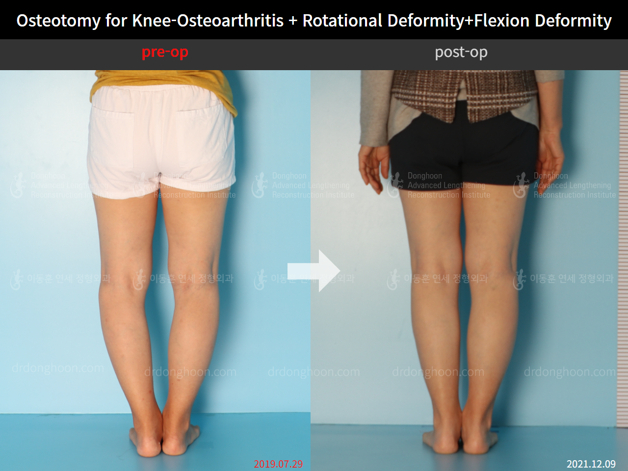 Before and after osteotomy for knee osteoarthritis, case 5987662, image 5, Dr. Donghoon institute (DALRI)