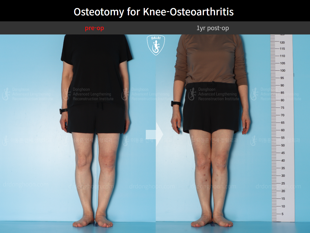 Before and after osteotomy for knee osteoarthritis, case 16893966, image 2, Dr. Donghoon institute (DALRI)