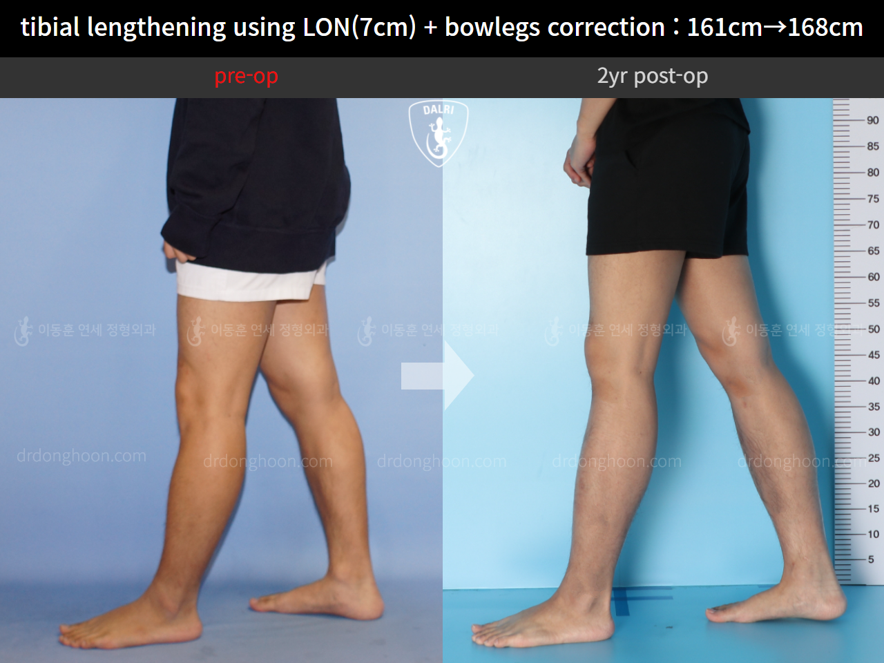Before and after cll + deformity correction, case 10400088, image 7, Dr. Donghoon institute (DALRI)