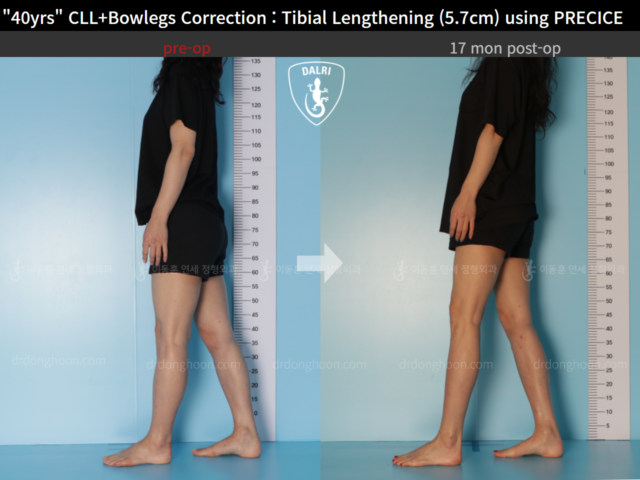 Before and after cll + deformity correction, case 9180907, image 4, Dr. Donghoon institute (DALRI)