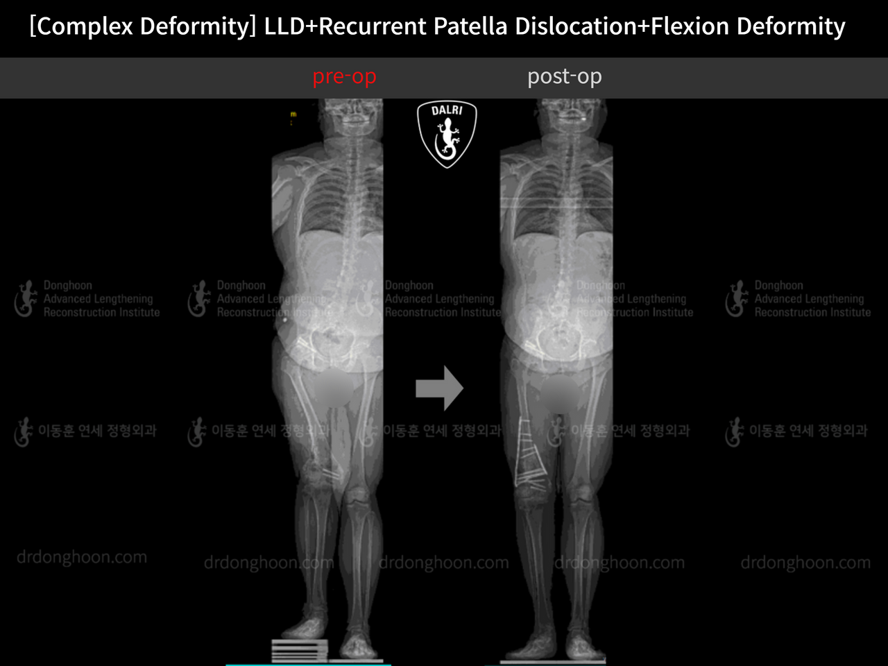 Before and after adult lld, case 12452703, image 4, Dr. Donghoon institute (DALRI)