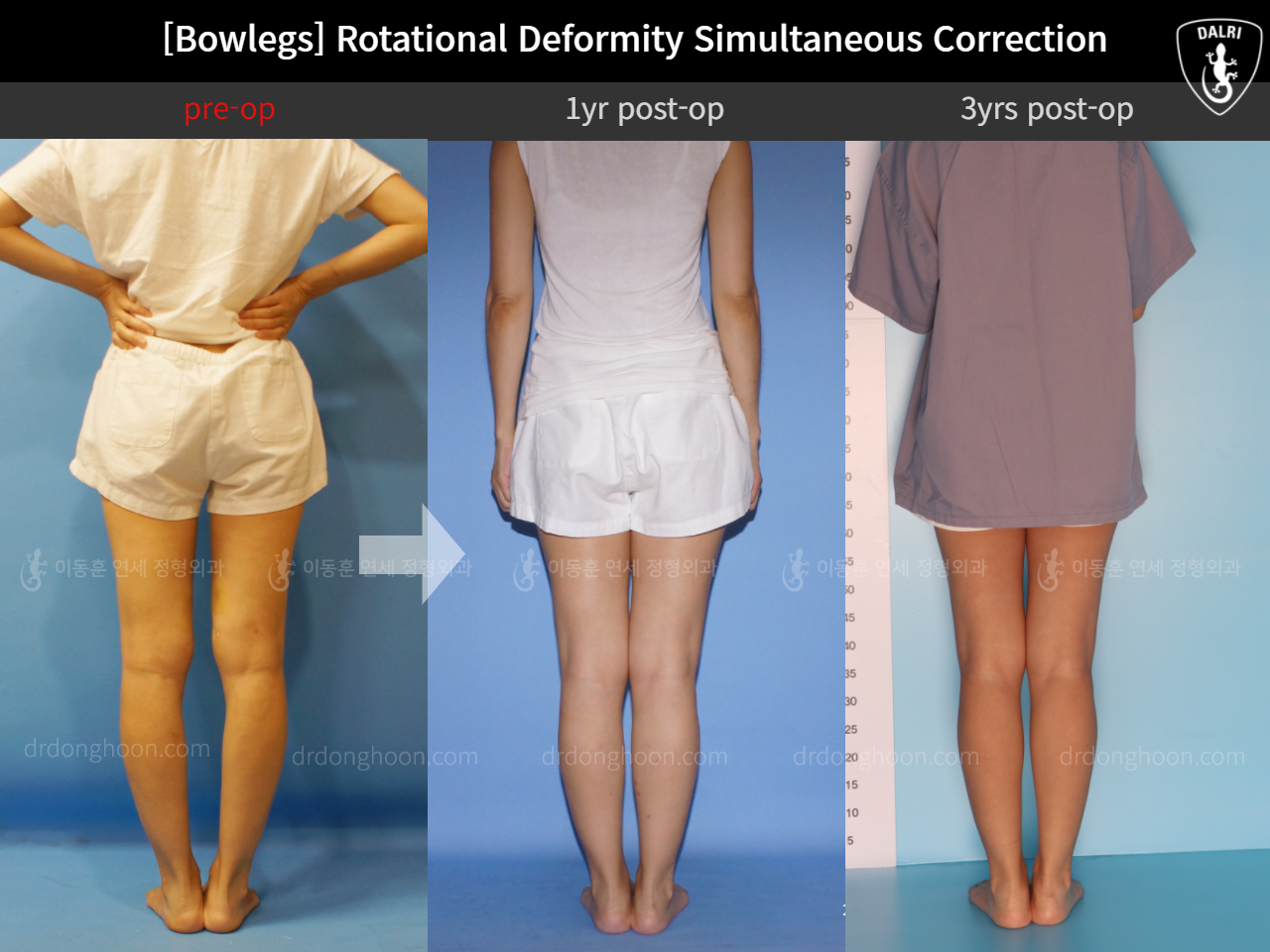 Before and after adult bowlegs, case 11789553, image 3, Dr. Donghoon institute (DALRI)