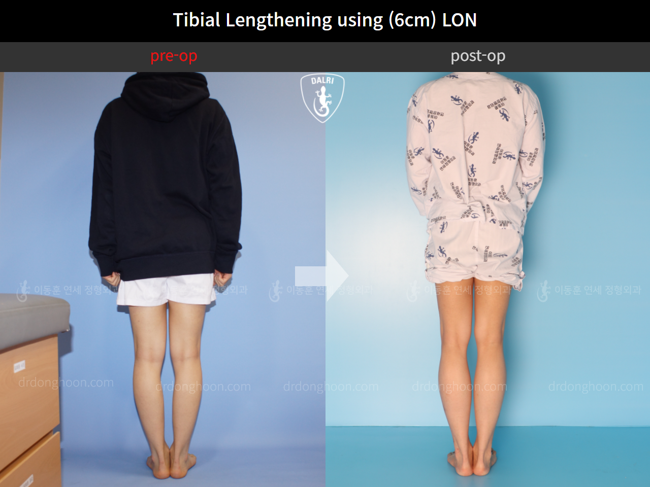 Before and after cll lon, case 4577694, image 2, Dr. Donghoon institute (DALRI)