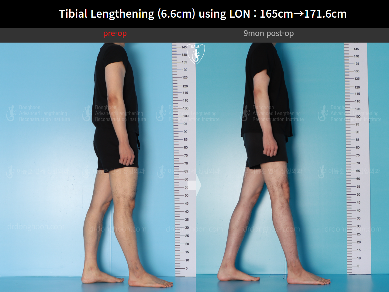 Before and after cll lon, case 16780660, image 7, Dr. Donghoon institute (DALRI)