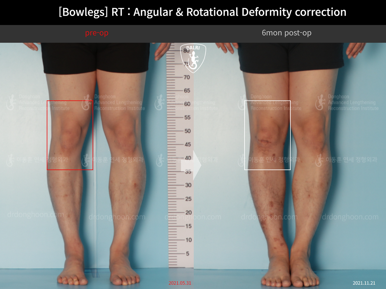 Before and after adult bowlegs, case 13664056, image 3, Dr. Donghoon institute (DALRI)
