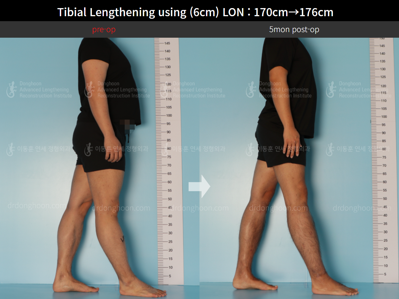Before and after cll lon, case 8672248, image 4, Dr. Donghoon institute (DALRI)