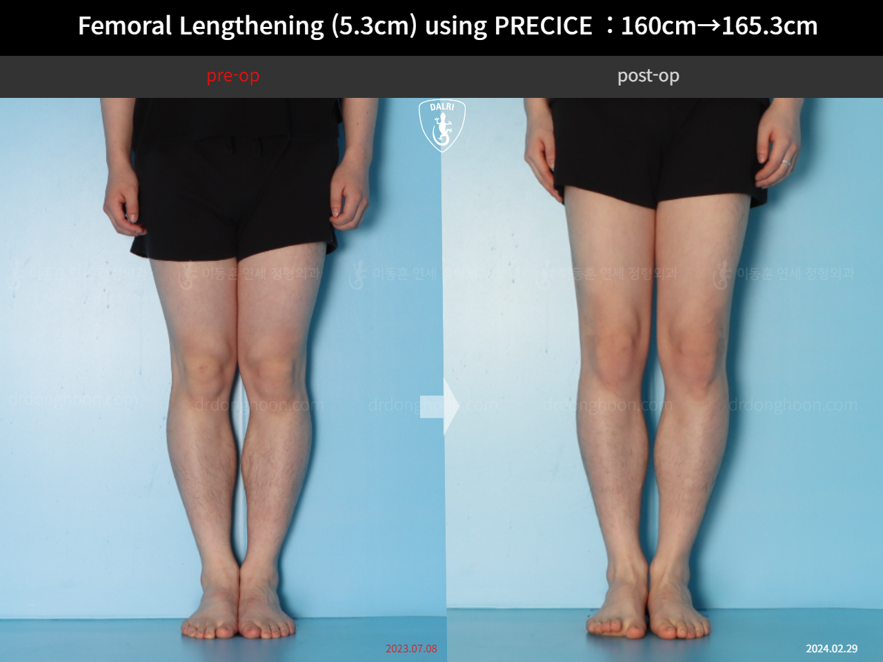 Before and after cll precice, case 18250566, image 7, Dr. Donghoon institute (DALRI)