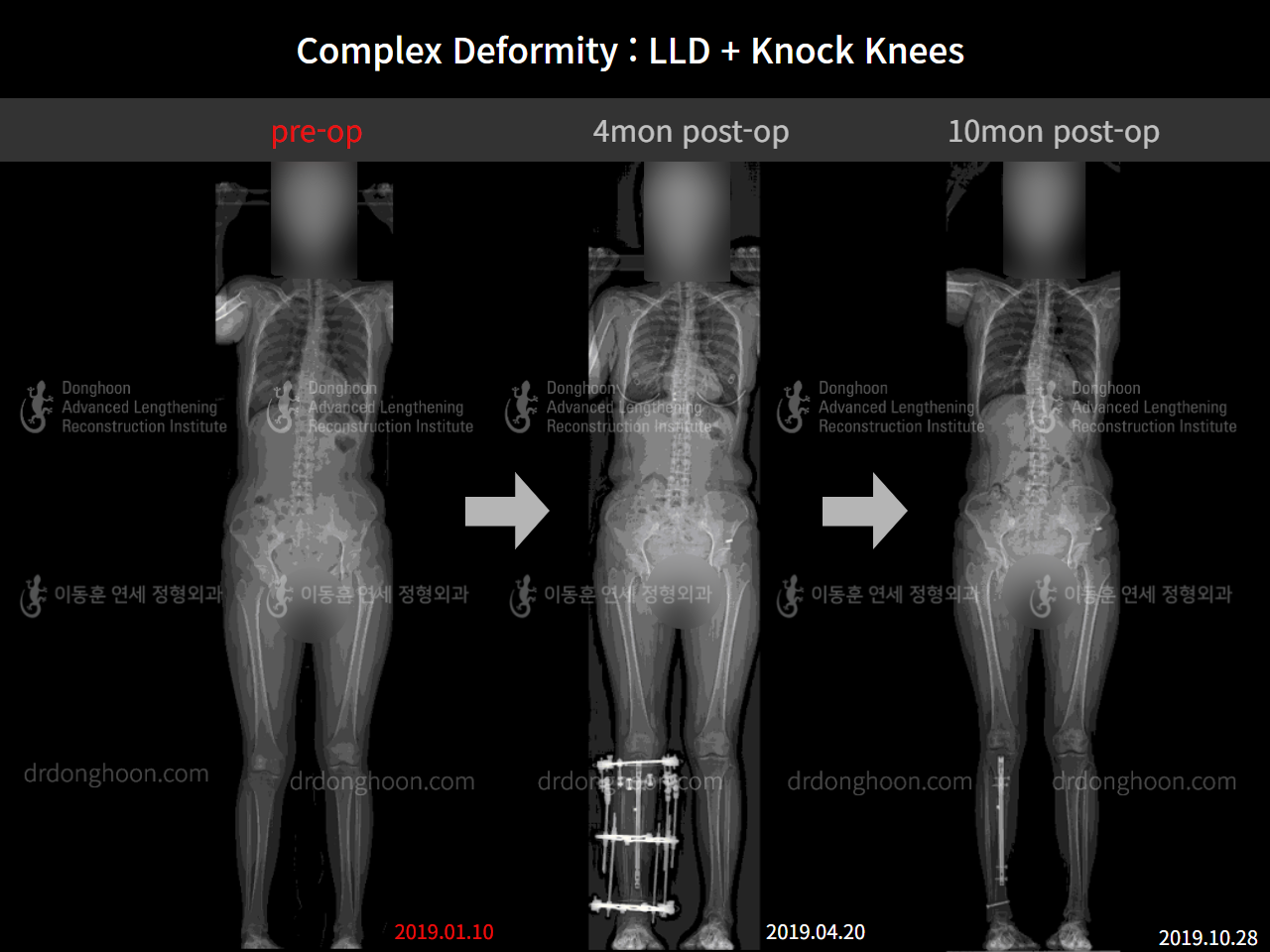 Before and after adult lld, case 9041582, image 5, Dr. Donghoon institute (DALRI)