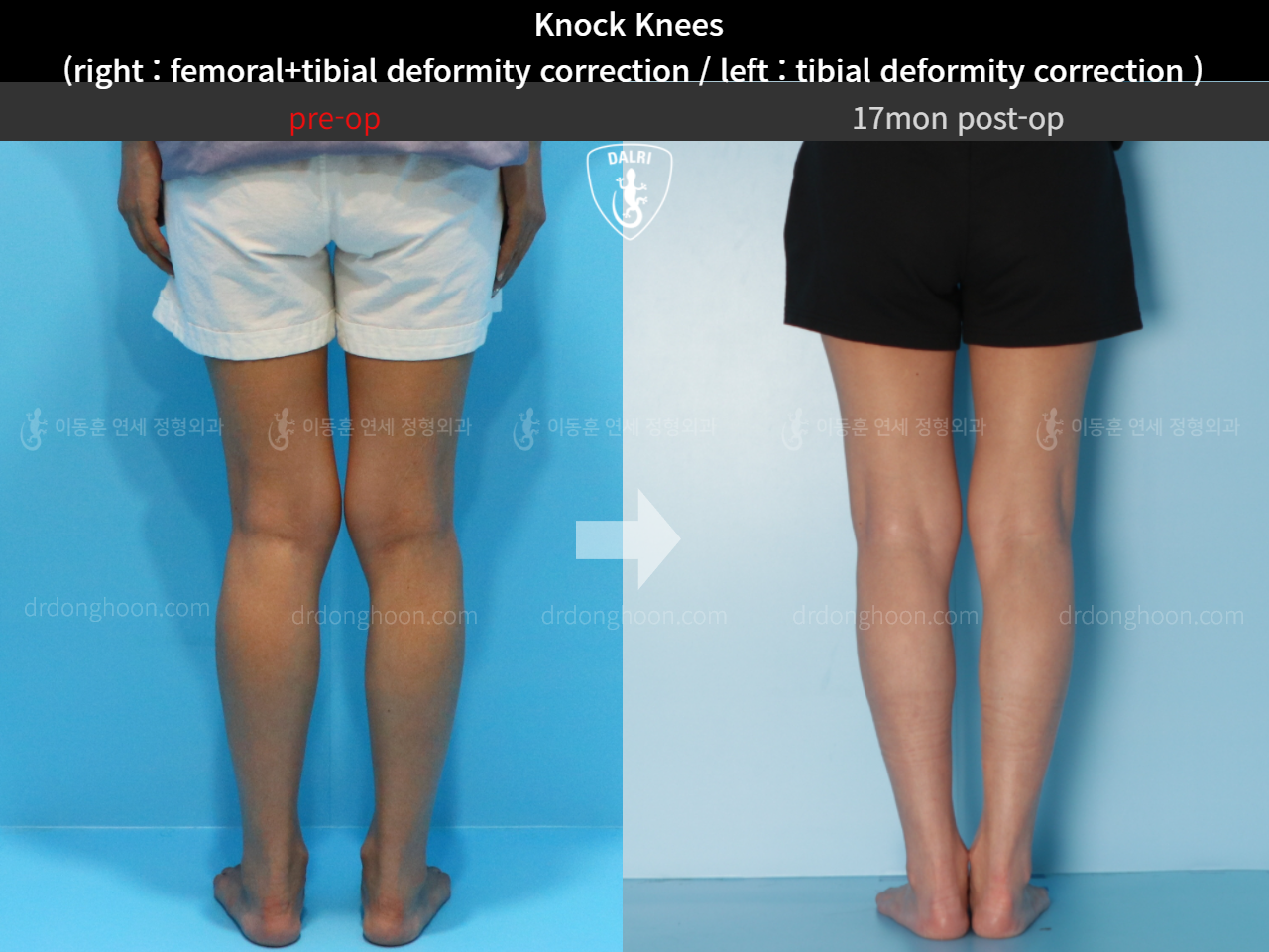 Before and after adult knock knees, case 4640565, image 4, Dr. Donghoon institute (DALRI)