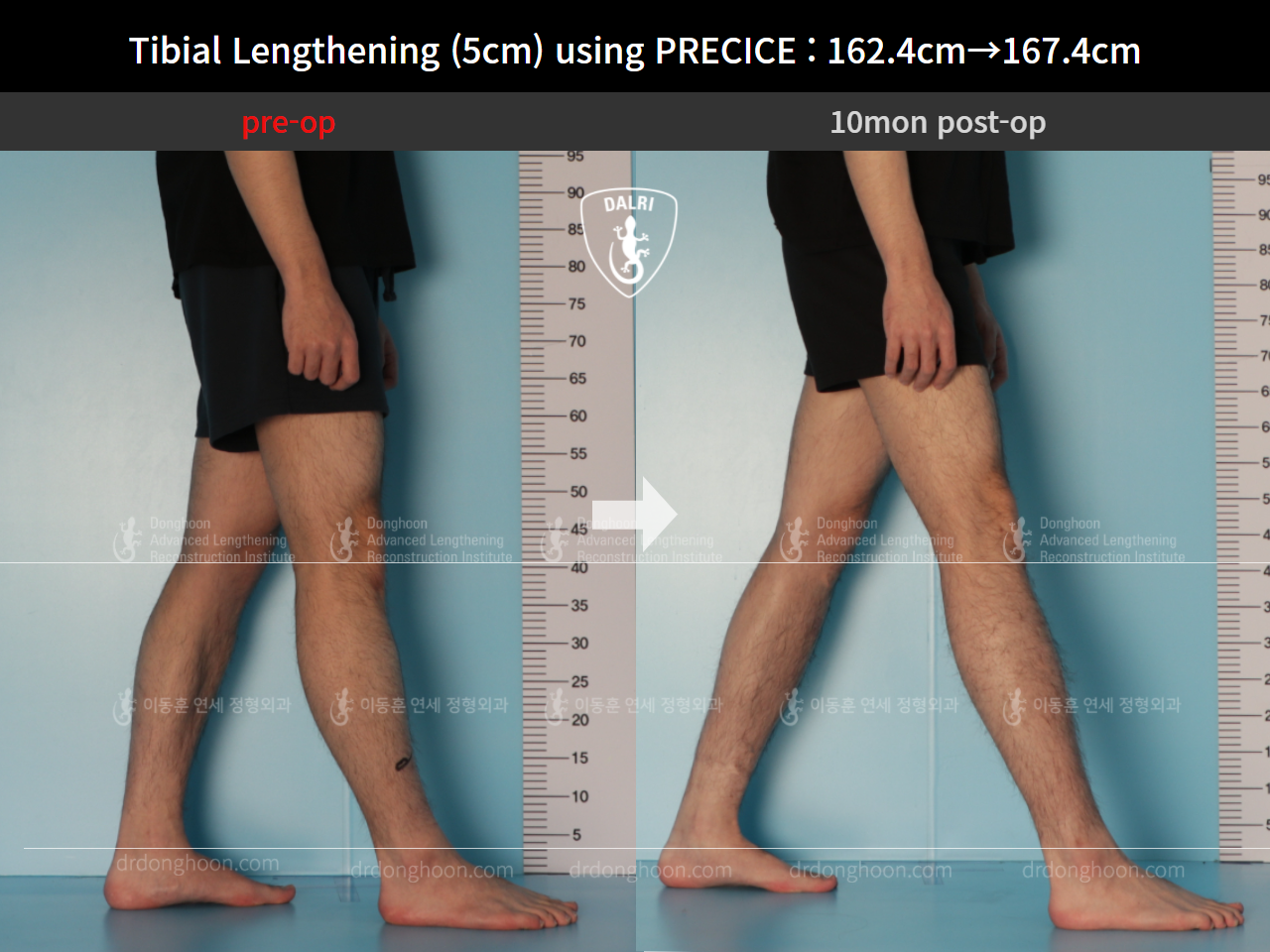 Before and after cll precice, case 9101885, image 8, Dr. Donghoon institute (DALRI)