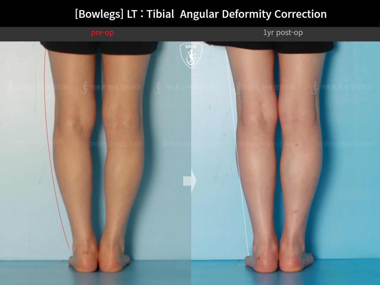 Before and after adult bowlegs, case 16787003, image 7, Dr. Donghoon institute (DALRI)