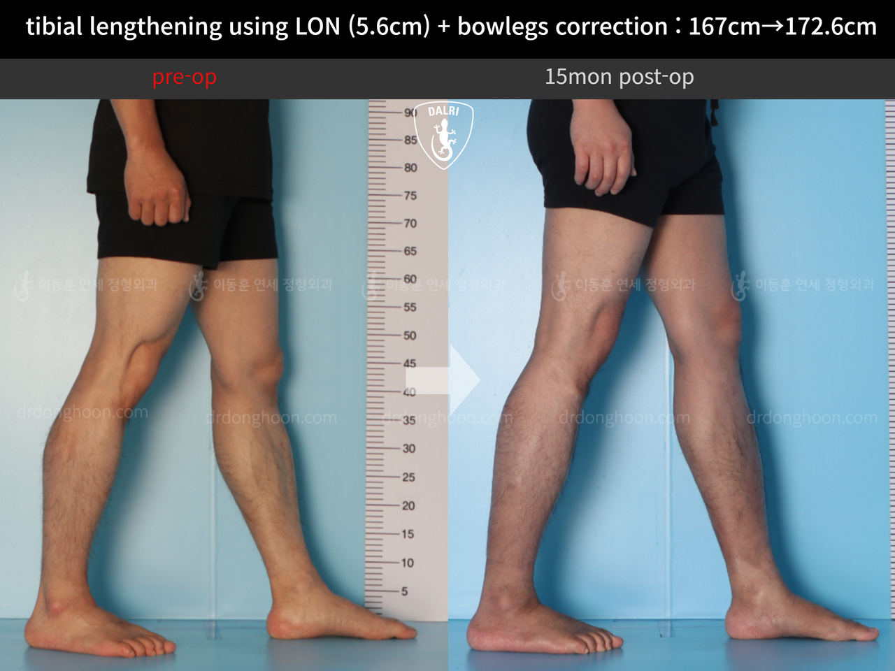 Before and after cll + deformity correction, case 12804946, image 8, Dr. Donghoon institute (DALRI)