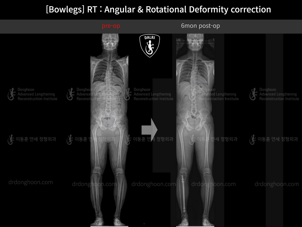 Before and after adult bowlegs, case 13664056, image 4, Dr. Donghoon institute (DALRI)