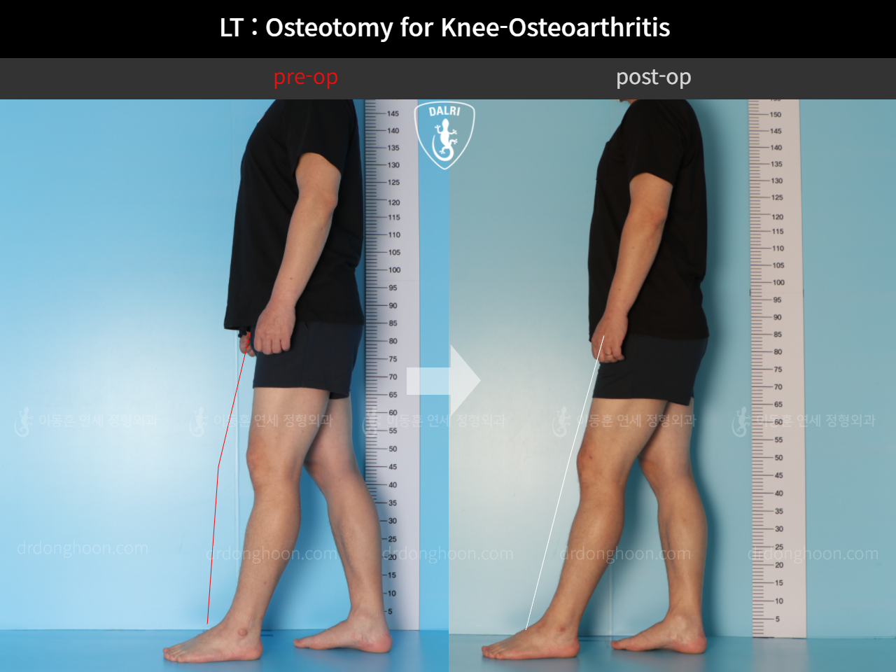 Before and after osteotomy for knee osteoarthritis, case 11065448, image 4, Dr. Donghoon institute (DALRI)