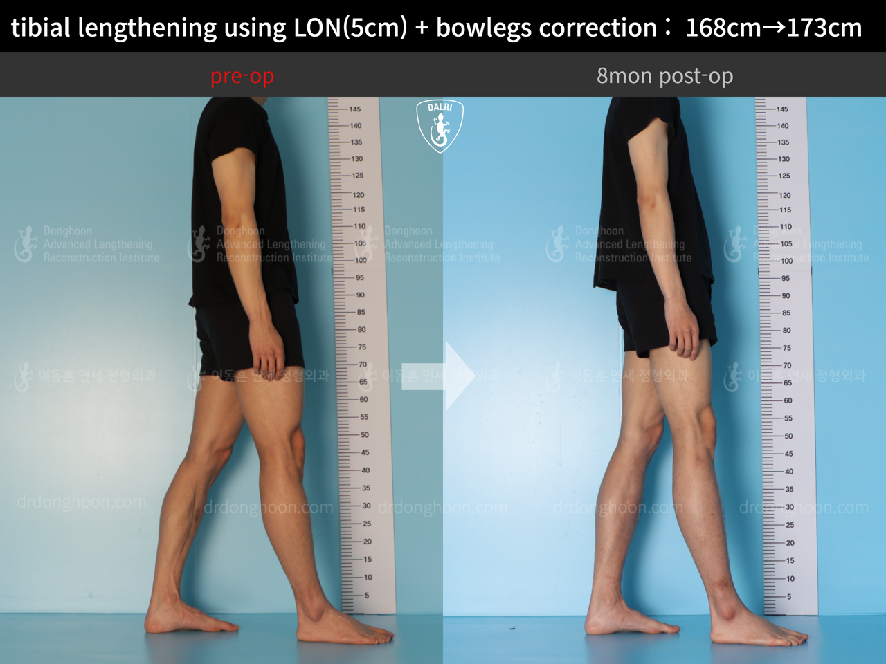 Before and after cll lon, case 13661175, image 3, Dr. Donghoon institute (DALRI)