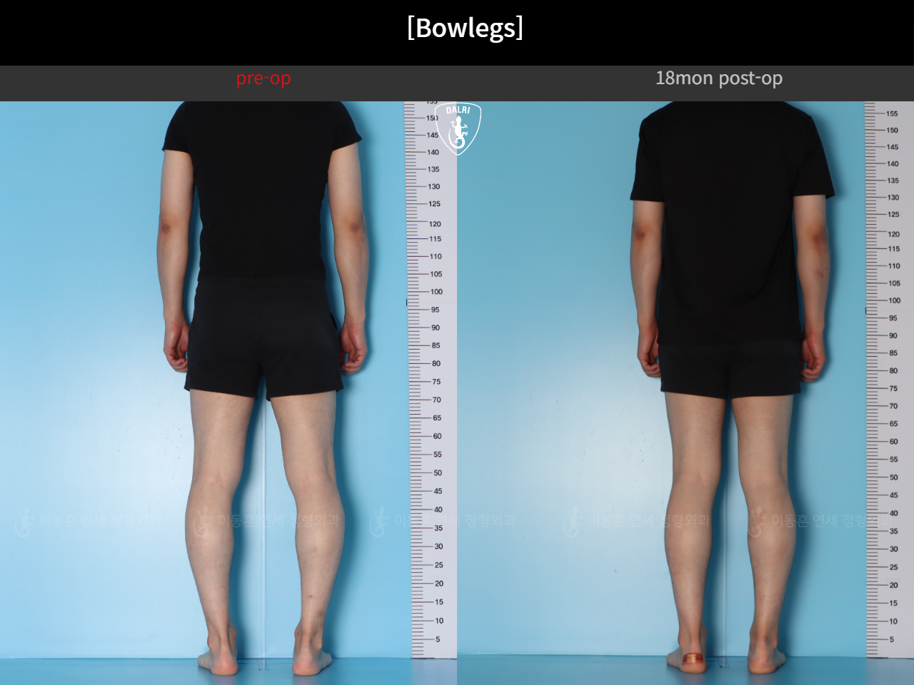 Before and after adult bowlegs, case 124254182, image 5, Dr. Donghoon institute (DALRI)