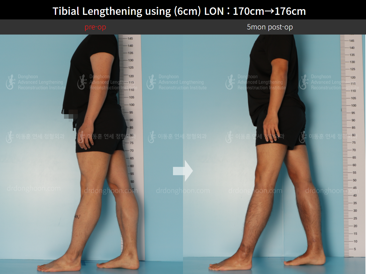 Tibial Lengthening Using (6cm) LON : 170cm→176cm : DALRI Before & After