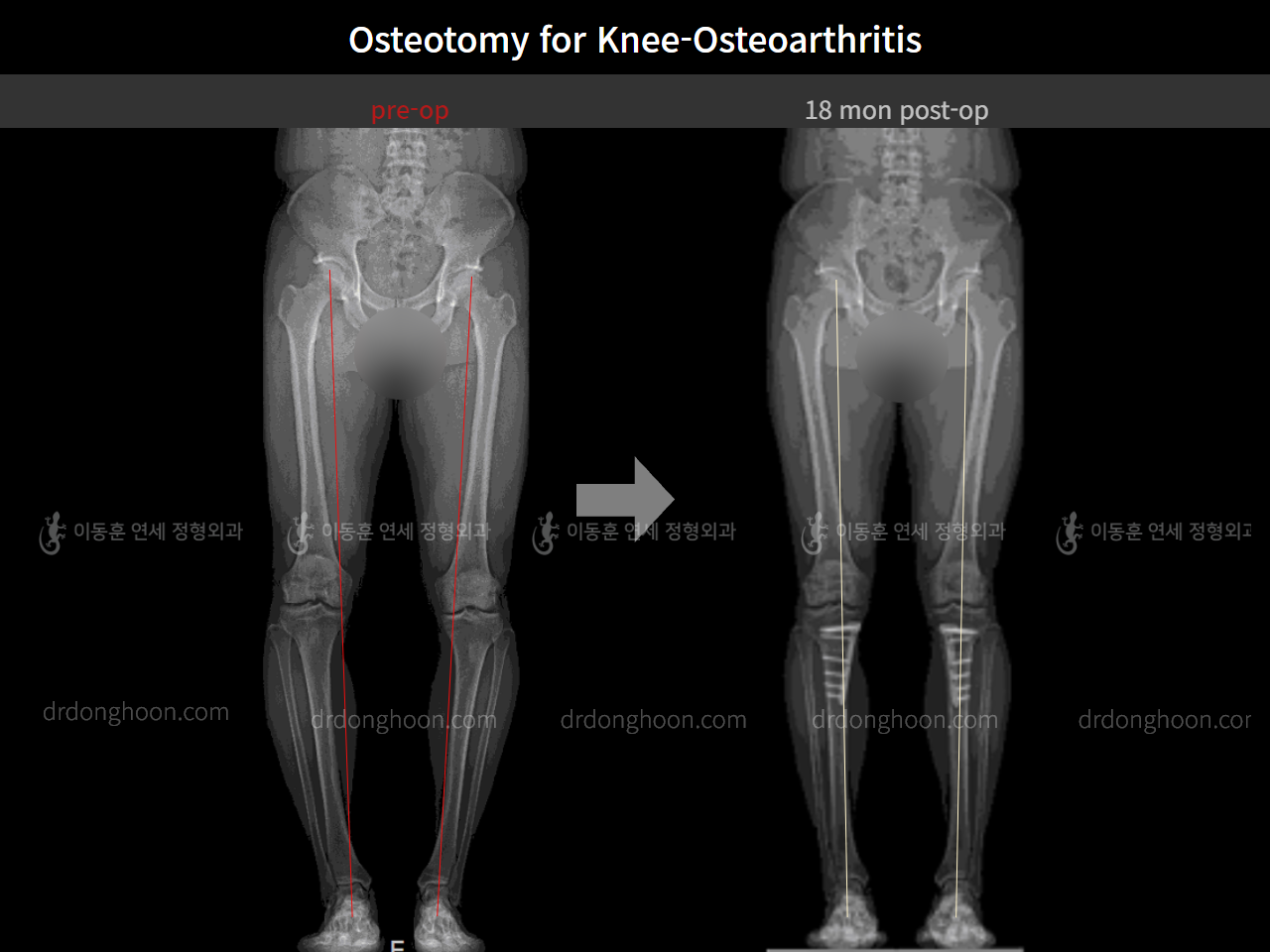 Before and after osteotomy for knee osteoarthritis, case 5394670, image 6, Dr. Donghoon institute (DALRI)