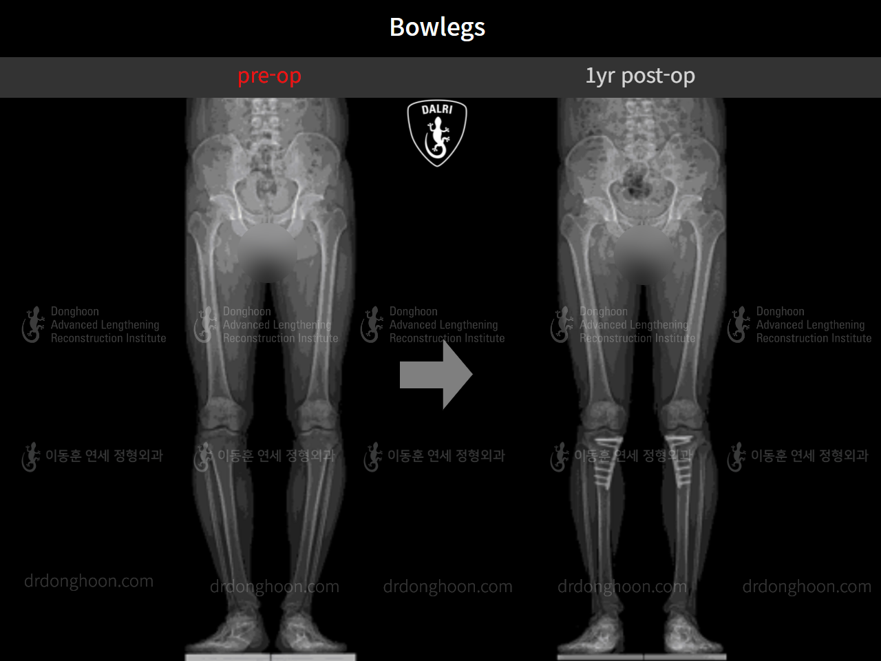 Before and after adult bowlegs, case 9487634, image 6, Dr. Donghoon institute (DALRI)