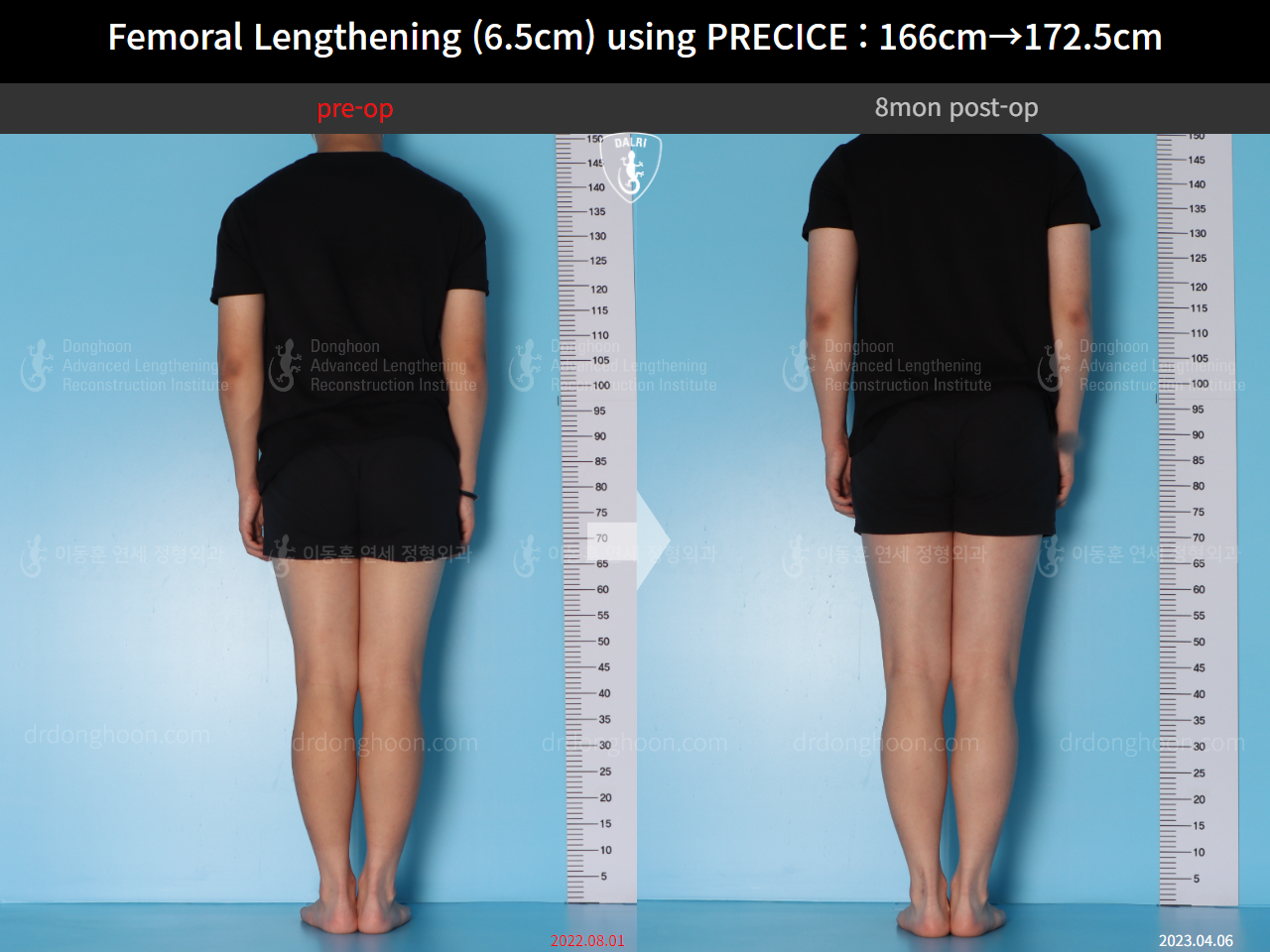 Before and after cll precice, case 14706614, image 3, Dr. Donghoon institute (DALRI)