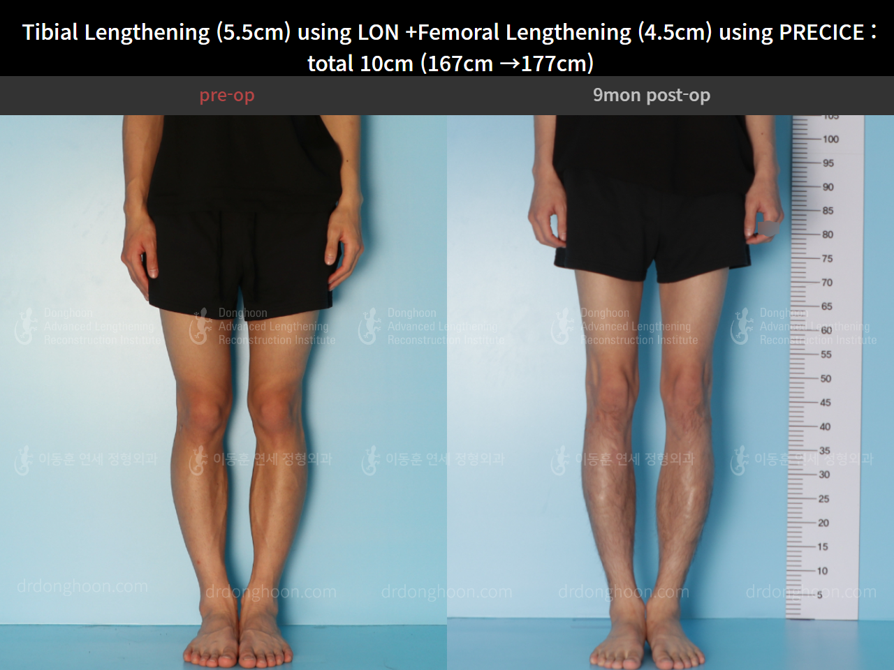 Before and after cll precice, case 4662233, image 5, Dr. Donghoon institute (DALRI)