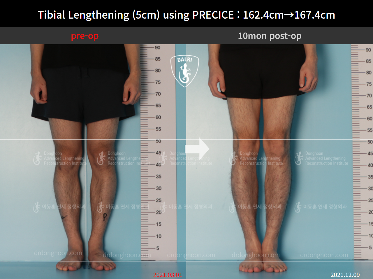 Before and after cll precice, case 9101885, image 5, Dr. Donghoon institute (DALRI)
