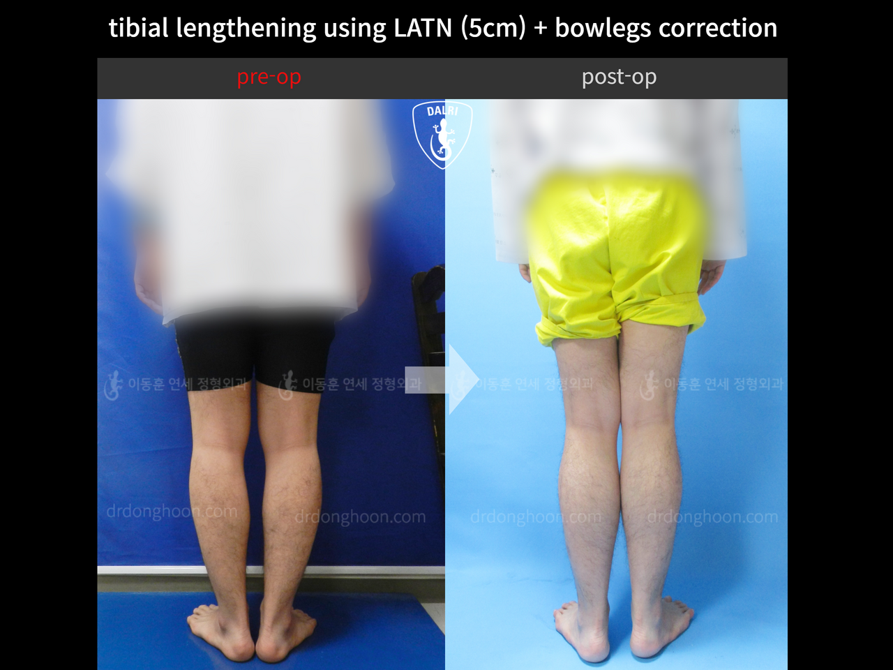 Before and after cll + deformity correction, case 4323109, image 2, Dr. Donghoon institute (DALRI)
